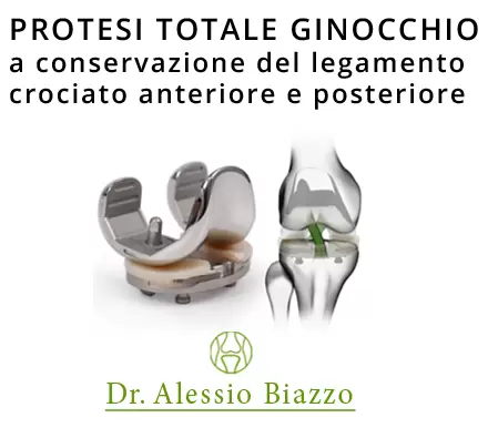 Protesi totale mininvasiva del ginocchio Protesi ginocchio totale