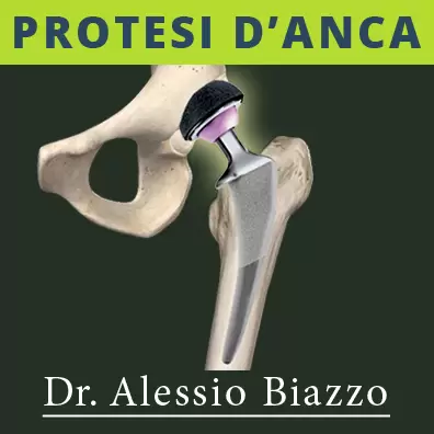 Protesi anca mininvasiva Dott Alessio Biazzo chirurgo ortopedico