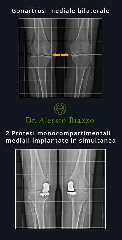 Protesi mininvasiva simultanea per gonartrosi mediale bilaterale gonartrosi mediale bilaterale dott alessio biazzo
