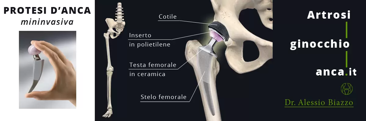 Protesi anca mininvasiva - Dott Alessio Biazzo