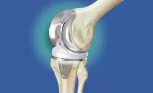 protesi totale ginocchio 300x182
