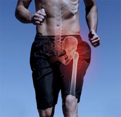 Protesi ginocchio e anca nello sportivo