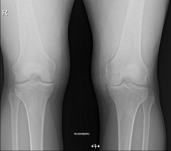 Medial knee osteoarthritis Fig - 1